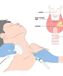 FNAC (FINE NEEDLE ASPI- RATION CYTOPATHOLOGY)