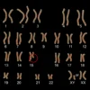 Prader-Willi Syndrome (Chromosome 15Q Deletion)