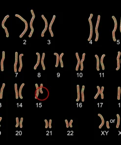 Prader-Willi Syndrome (Chromosome 15Q Deletion)