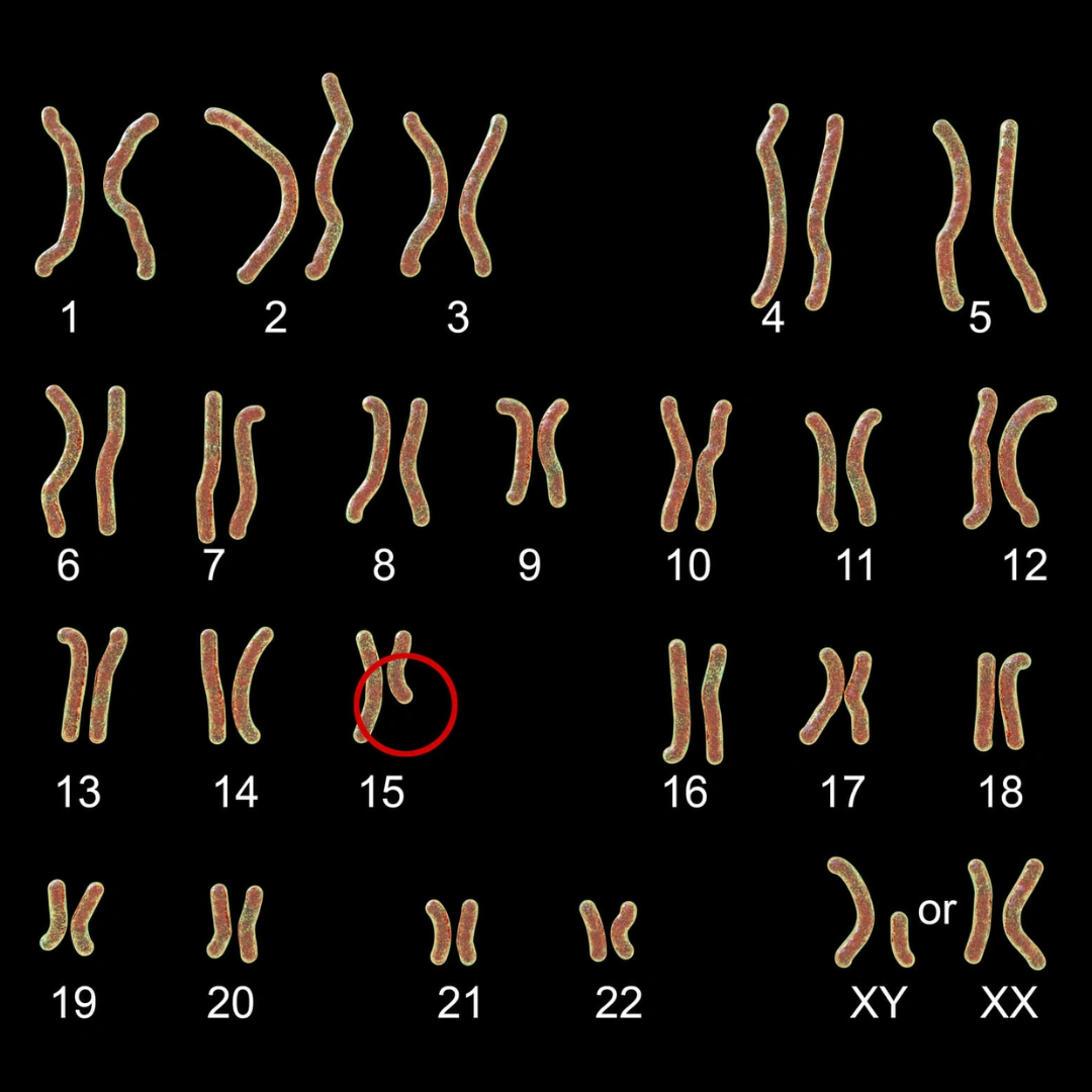 Prader-Willi Syndrome (Chromosome 15Q Deletion)
