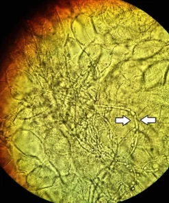 FUNGAL SMEAR EXAMINATION