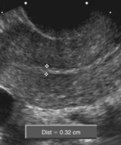 Product Of Conception (1St Trimester Abortion)