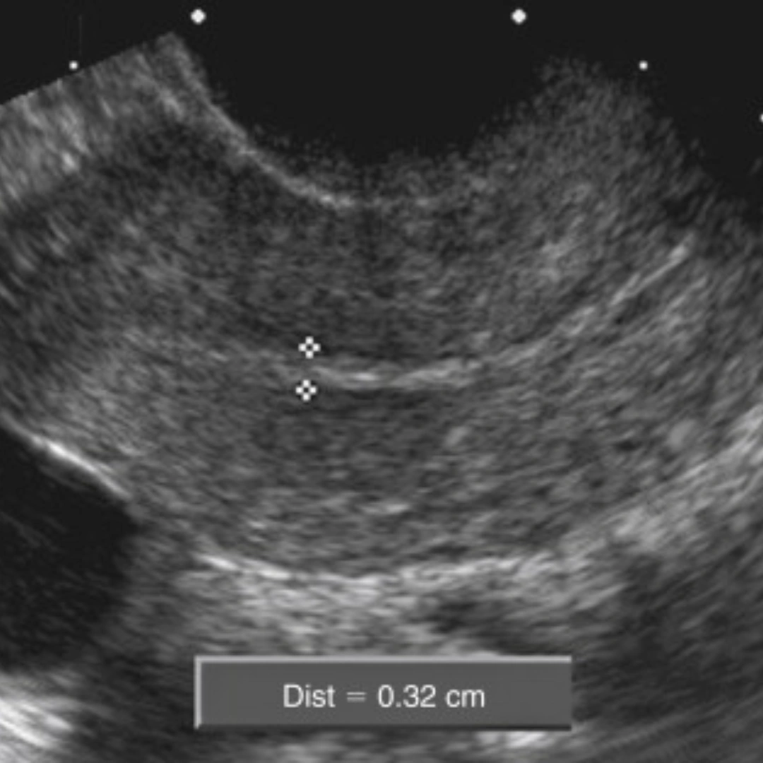 Product Of Conception (1St Trimester Abortion)