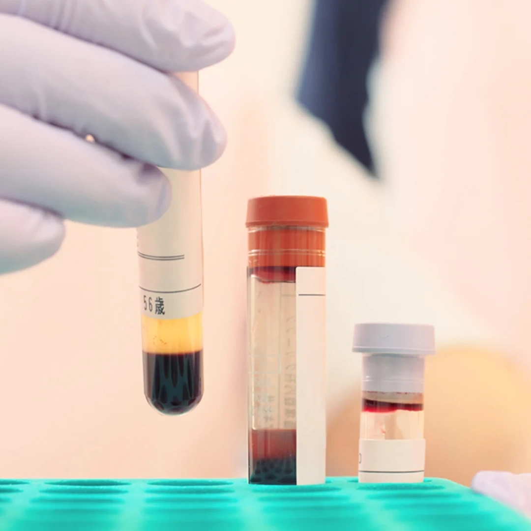 Protein Electrophoresis, Serum