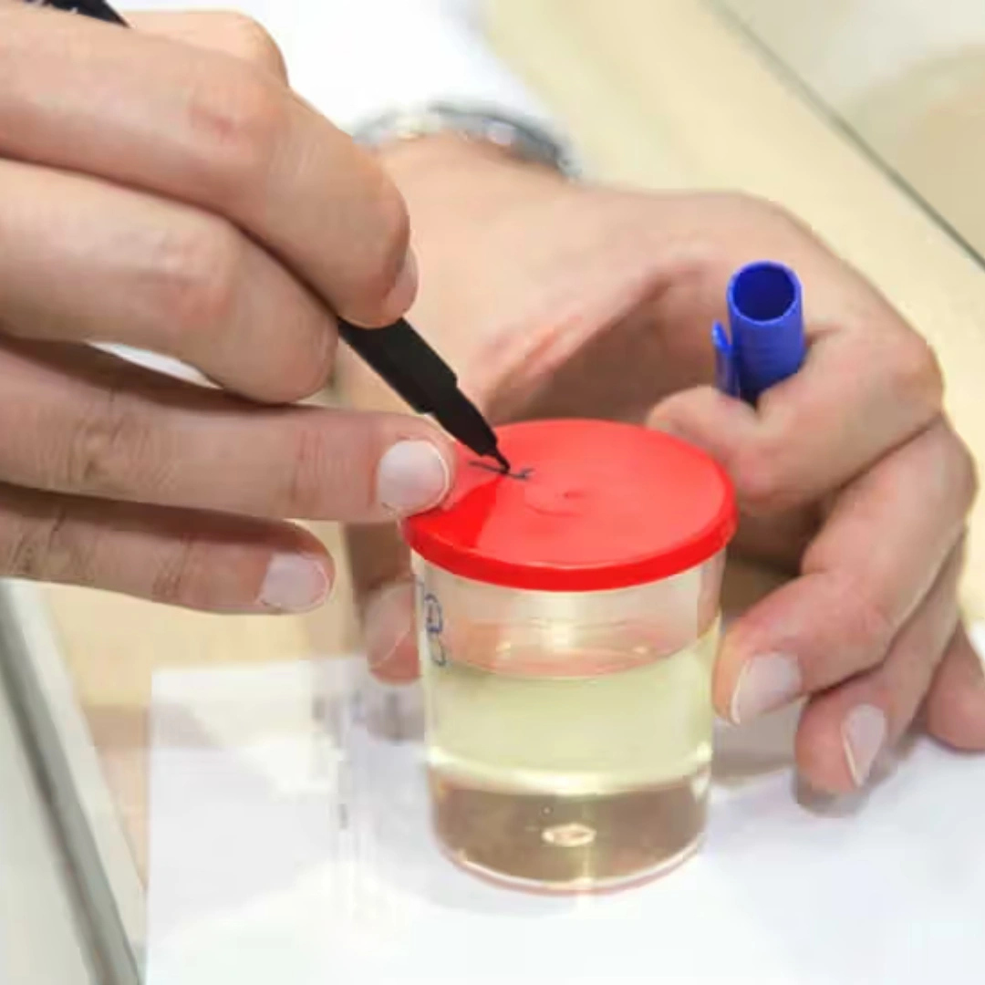 Protein Electrophoresis, Urine