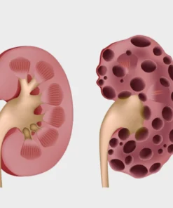 Nor Metanephrine Urine
