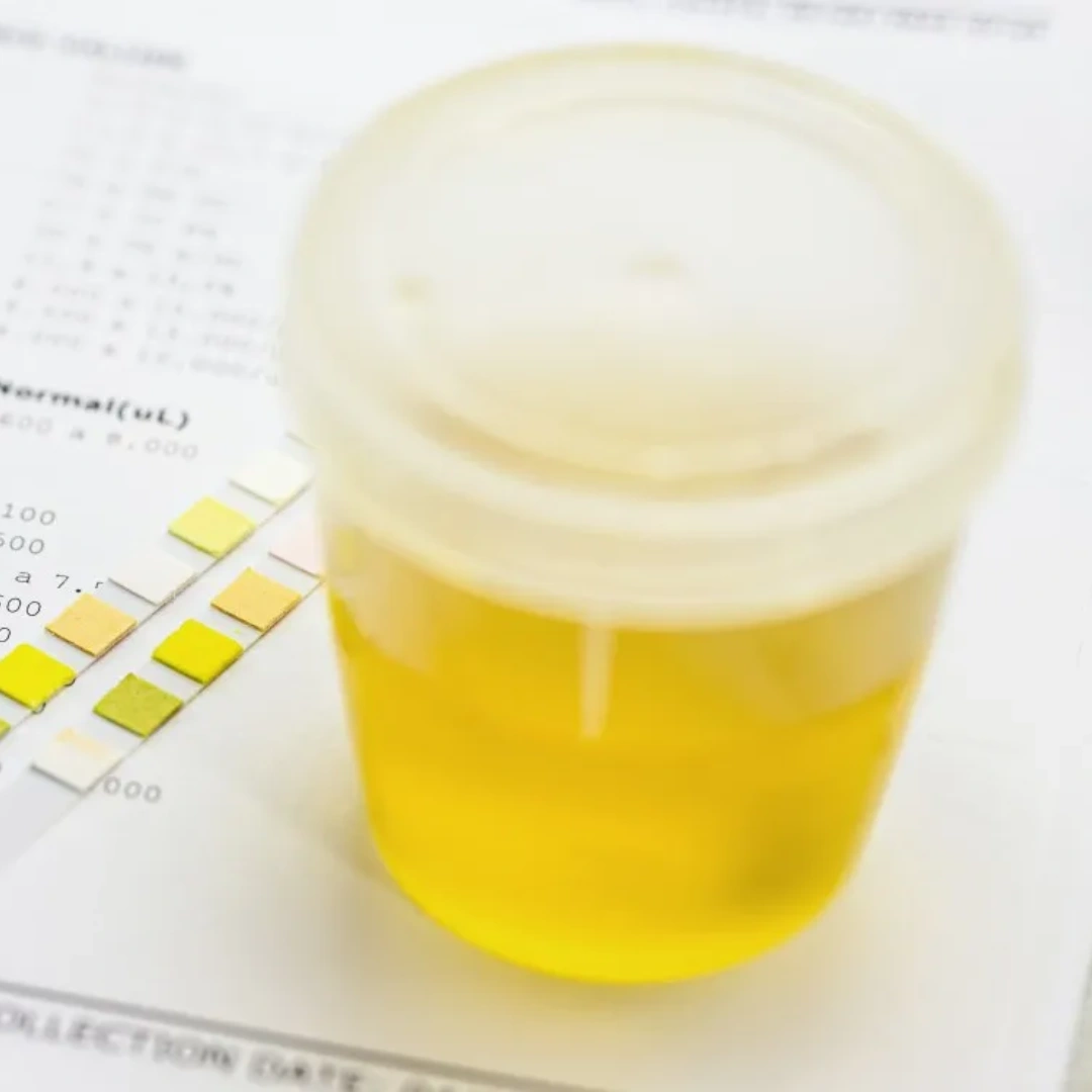 Protein, 24 Hrs Urine