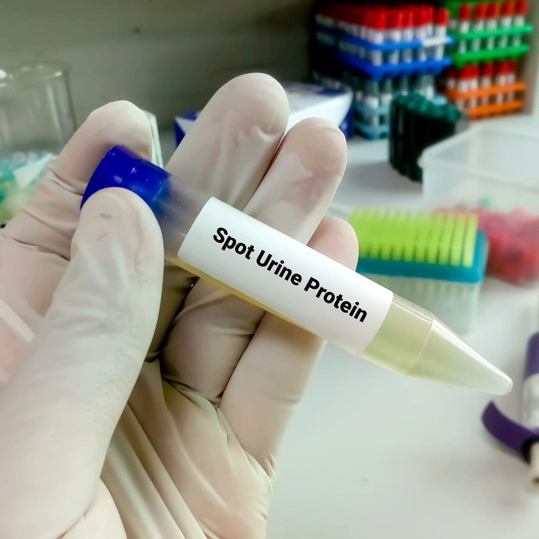 Protein, Random Urine