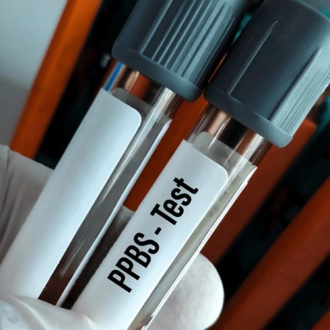 GLUCOSE POST-PRANDIAL, PLASMA