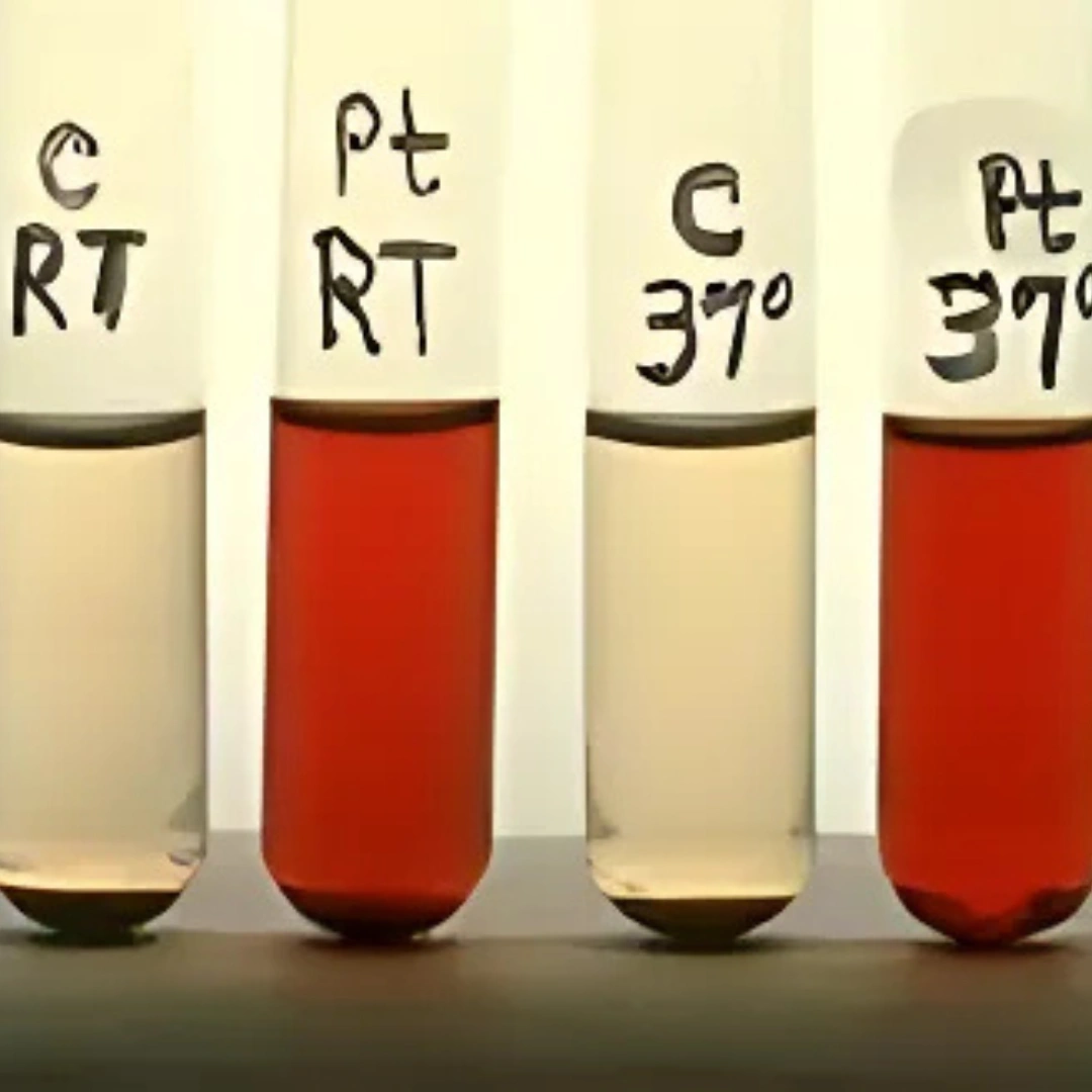 HAM TEST (ACIDIFIED SERUM LYSIS TEST)