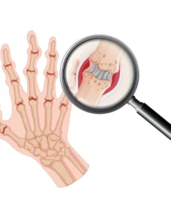 Rheumatoid Factor (Qualitative), Serum