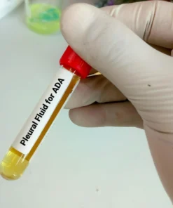 Pleural Fluid, Routine Examination